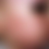 Acne infantum. Zahlreiche, dicht stehende Papeln und Pusteln bei einem 3-jährigen Jungen.