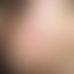 Acne infantum. Multiple, chronisch aktive, an Wangen und Stirn lokalisierte, disseminierte, feste...