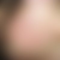 Acne infantum. Multiple, chronisch aktive, an Wangen und Stirn lokalisierte, disseminierte, feste...