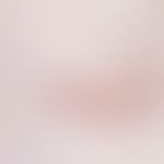 Akne, Keloid-Akne. Mit Narbenkeloiden ausgeheilte Acne vulgaris.