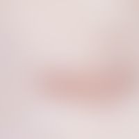 Acne, keloid acne. Acne vulgaris cured with scar keloids.