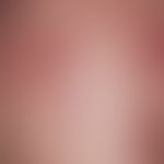 Akne, Keloid-Akne. Acne papulo-pustulosa neben Narbenkeloiden abgeheilter Effloreszenzen in der S...