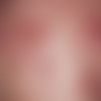 Acne, keloid acne, acne papulo-pustulosa next to scar keloids of healed efflorescences in the sho...