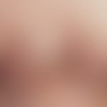 Akne, Keloid-Akne. Strangförmige, derbe, bräunlich pigmentierte Erhabenheiten im Brustbereich bei...
