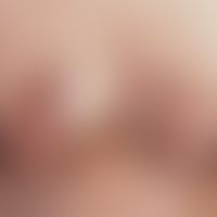 Acne, keloid acne. stringy, coarse, brownish pigmented elevations in the chest area in a 24-year-...