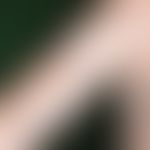 Acne, Mallorca acne, follicularly bound papules after UV exposure.
