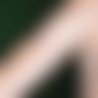 Acne, Mallorca acne, follicularly bound papules after UV exposure.
