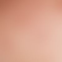Acne, Mallorca acne, follicularly bound papules after sun exposure.
