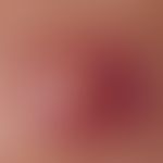 acne, majorca acne. single papules. round papules with ectatic papillary capillaries. in the surr...