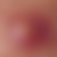 acne, majorca acne. single papules. round papules with ectatic papillary capillaries. in the surr...