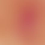 Acne, Mallorca acne, ectatic central capillaries, yellowish-opaque (pus) and honey-yellow translu...