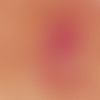 Acne, Mallorca acne, ectatic central capillaries, yellowish-opaque (pus) and honey-yellow translu...