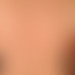 Acne, Mallorca acne. acute (after sun exposure 14 days ago), in UV-exposed areas (especially face...