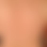 Acne, Mallorca acne. acute (after sun exposure 14 days ago), in UV-exposed areas (especially face...