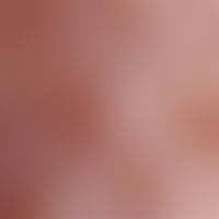 Acne, oil acne. reflected light microscopy: follicular hyperkeratosis, partially with central vel...