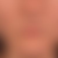 Acne papulopustulosa: in acne-typical distribution, with large-pored skin, red smooth and excoria...