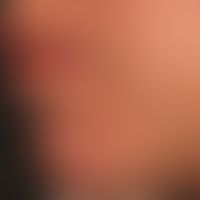 Acne papulopustulosa:&nbsp;zahlreiche Pusteln sowie ältere und frische Narben.
