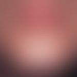 Multiple, flat, reddish papules and spots in the perioral and chin region after chronic use of a ...
