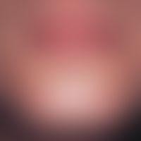 Acne venenata. Multiple, flache, rötliche Papeln und Flecken in der Perioral- und Kinnregion nach...