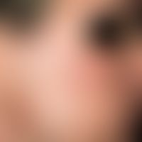 Acne vulgaris (overview): severe clinical picture with inflammatory papules, papulo-pustules and ...
