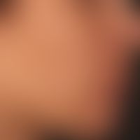 Acne papulopustulosa: disseminated follicular papules, pustules and retracted scars; recurrent co...