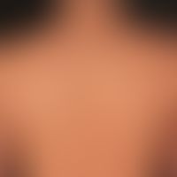 Acne vulgaris:&nbsp;zahlreiche, z.T. schmerzhafte Keloide, nach weitgehend abgeheilter Acne vulga...