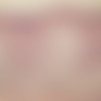 Akroangiodermatitis: kräftige Epidermishyperplasie. Im oberen Korium zahlreiche Glomerate aus que...