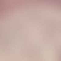 Akroangiodermatitis (Detailvergrößerung): In einer Papille, zahlreiche quere und schräge Anschnit...