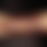 Acroangiodermatitis. several brownish reddish, blurred plaques confluent to a large area in a 39-...