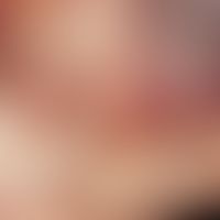 Akroangiodermatitis&nbsp;(Detail aus vorheriger&nbsp;Abbildung):&nbsp;Aus kleinsten roten (hämorr...