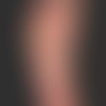 Akrokeratose paraneoplastische; erworbene, spikeartige Hyperkeratosen&nbsp;an Handflächen und Fuß...