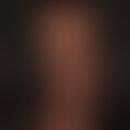 Acromegaly: 43-year-old patient with known acromegaly. Noticeable increase in size of the lower e...