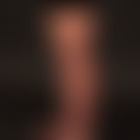 Acromegaly: 43-year-old patient with known acromegaly. Noticeable increase in size of the lower e...