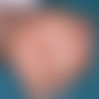 Acropustulosis, infantile. disseminated, partly individually, partly grouped standing papules, ve...