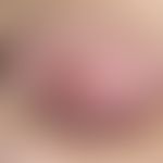 Acrocyanosis; diffuse reddish-livid skin discoloration of both mammae only occurring in cold weat...