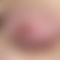 Acrocyanosis; diffuse reddish-livid skin discoloration of both mammae only occurring in cold weat...