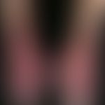 acrocyanosis. acute, changeable, homogeneously laminar, reddish-livid skin discoloration with red...
