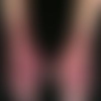 acrocyanosis. acute, changeable, homogeneously laminar, reddish-livid skin discoloration with red...