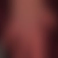 Acrocyanosis in right heart failure in age-related atrophic, shiny skin with solar lentigines on ...