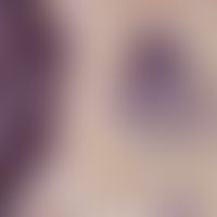 Aktinomykose. Actinomyces israelii in der Randzone einer Druse (Detailvergrößerung); Gram-Färbung...