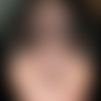 Alopecia androgenetica beim Mann. Stadium II/III: Zurücktreten der Stirn-Haar-Grenzen, insbes. an...