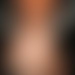 Alopecia androgenetica beim Mann. Stadium III/IV: Konfluenz der vorderen und hinteren Haarlichtun...