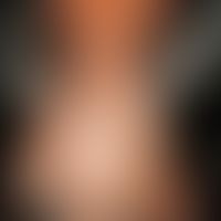 Alopecia androgenetica beim Mann. Stadium III/IV: Konfluenz der vorderen und hinteren Haarlichtun...