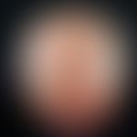 Alopecia androgenetica beim Mann. Stadium IV: Hufeisenförmige, komplette Lichtung der Haare im Pa...