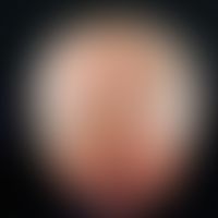 Alopecia androgenetica beim Mann. Stadium IV: Hufeisenförmige, komplette Lichtung der Haare im Pa...