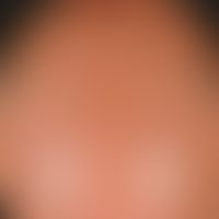 Alopecia androgenetica beim Mann. Stadium V: Nahezu kompletter Haarverlust mit schmalem dünnen se...