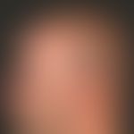Alopecia androgenetica beim Mann. Stadium IV: Verbleibender seitlicher und hinterer Haarkranz bei...