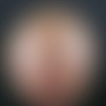 Alopecia androgenetica beim Mann. Stadium V: Vollständiger Verlust der Haare im Parietalbereich. ...