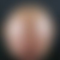 Alopecia androgenetica beim Mann. Stadium V: Vollständiger Verlust der Haare im Parietalbereich. ...