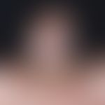 Alopecia androgenetica bei der Frau. Übersichtsaufnahme: Stadium III: Ausgeprägte Haarlichtung im...